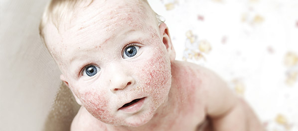 Dziecko z atopowym zapaleniem skóry